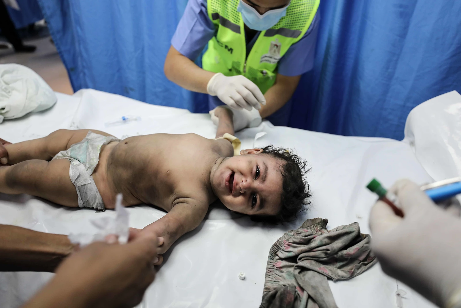 An infant lies on a gurney, appearing distressed, with medical personnel attending.
